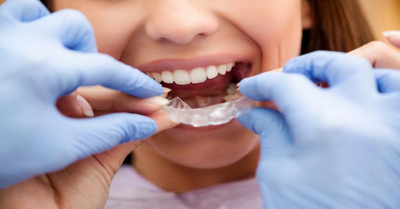 Afinal, o que podemos esperar do sistema Invisalign? – Dental
